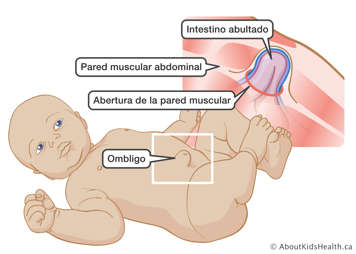 Ilustración del intestino sobresaliendo a través de una apertura en la pared muscular del abdomen de un bebé