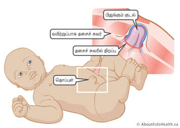 குழந்தையின் அடிவயிற்றில் உள்ள தசைச் சுவர்த் துவாரத்தின் ஊடாக வெளித்தள்ளும் சிறுகுடல் பற்றிய விளக்கப்படம்