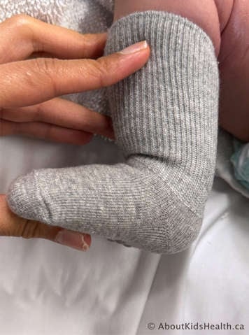 Child with clubfoot with caregiver bending the child’s knee and flexing the ankle upward