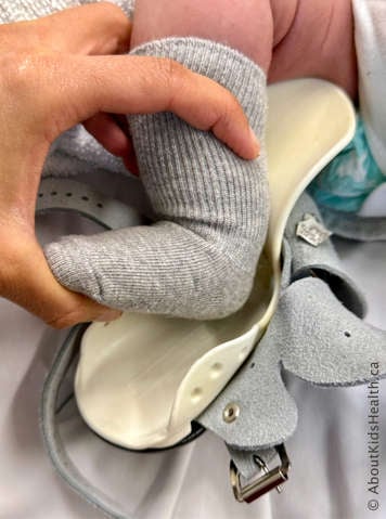 Child with clubfoot with caregiver bending the child’s knee and flexing the ankle upward as they place the foot into the boot