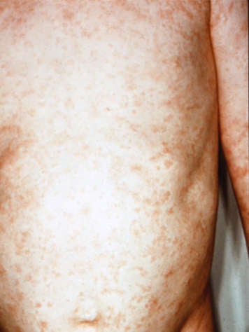 Torso of child with roseola rash