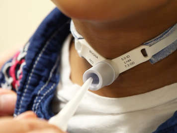 Suctioning a tracheostomy tube with a tip adapter.