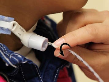 Twirling the tracheostomy suction catheter