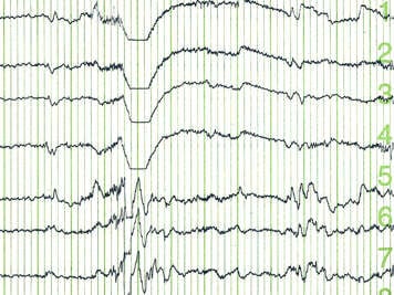 Electroencephalogram patterns