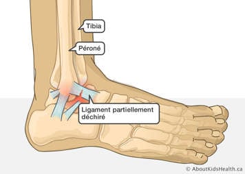Le tibia, le péroné et un ligament dans la cheville partiellement déchiré