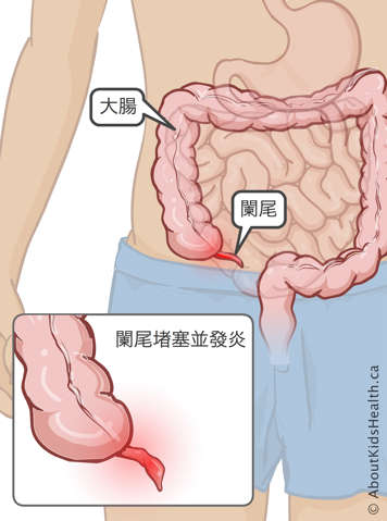 大腸和闌尾在人體內的位置,以及堵塞、發炎闌尾示意圖