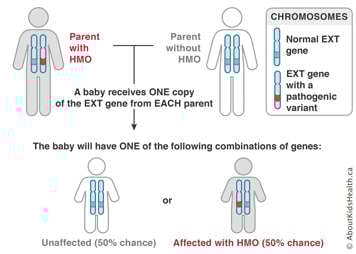 Chromosome distribution from an affected parent with HMO and an unaffected parent shows 50% chance of baby with HMO