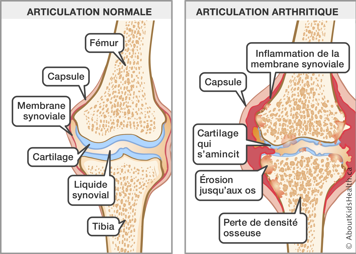 Articulation du genou normale et articulation du genou arthritique